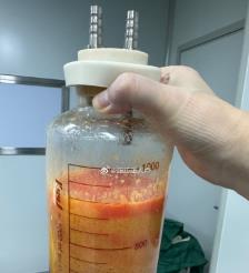 灯塔水动力吸脂手术要做多久？